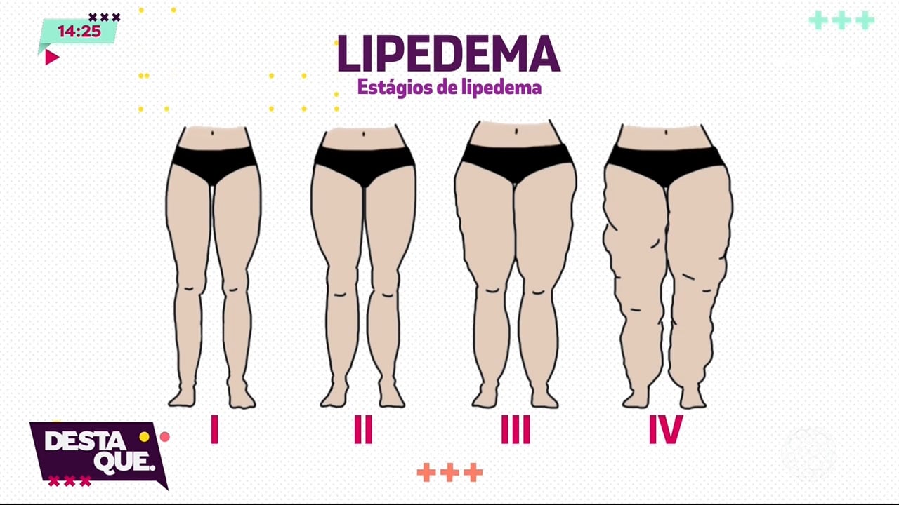 Entenda mais sobre o lipedema, a doença da gordura nas pernas - Massa News