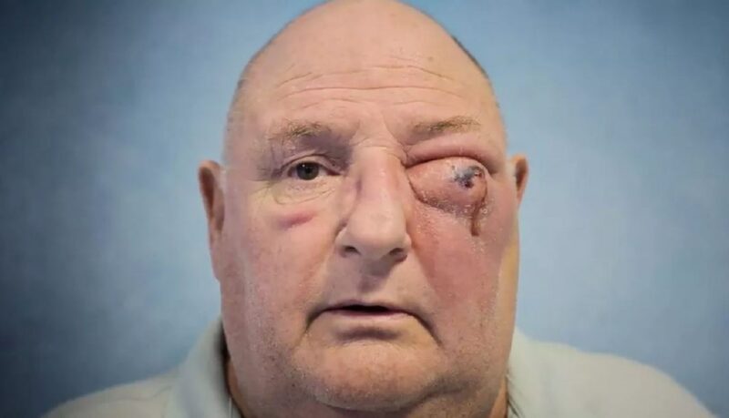 Homem fica cego de um olho após infecção dentária se espalhar